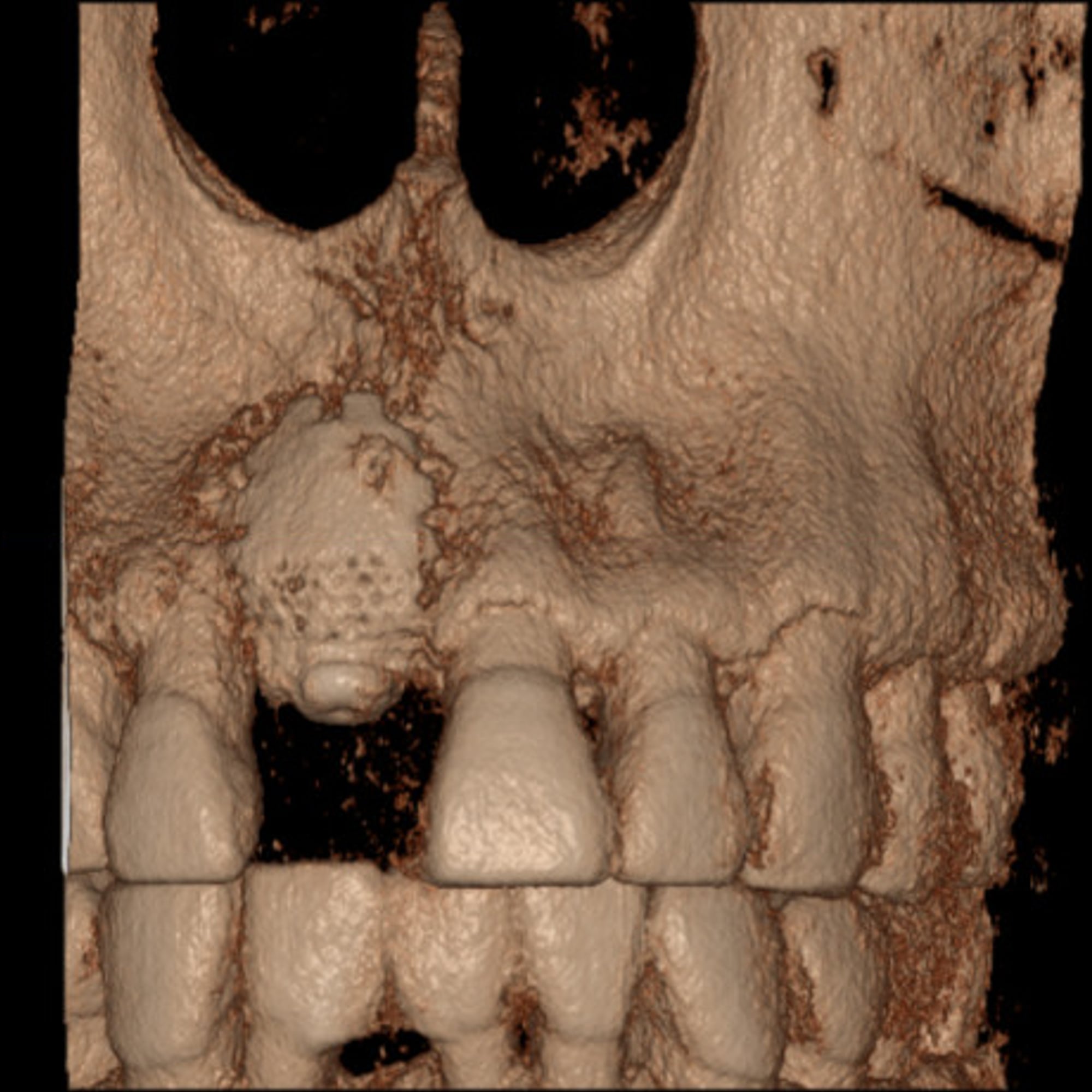 CBCT 3D reconstruction after treatment, with the buccal contour restored
