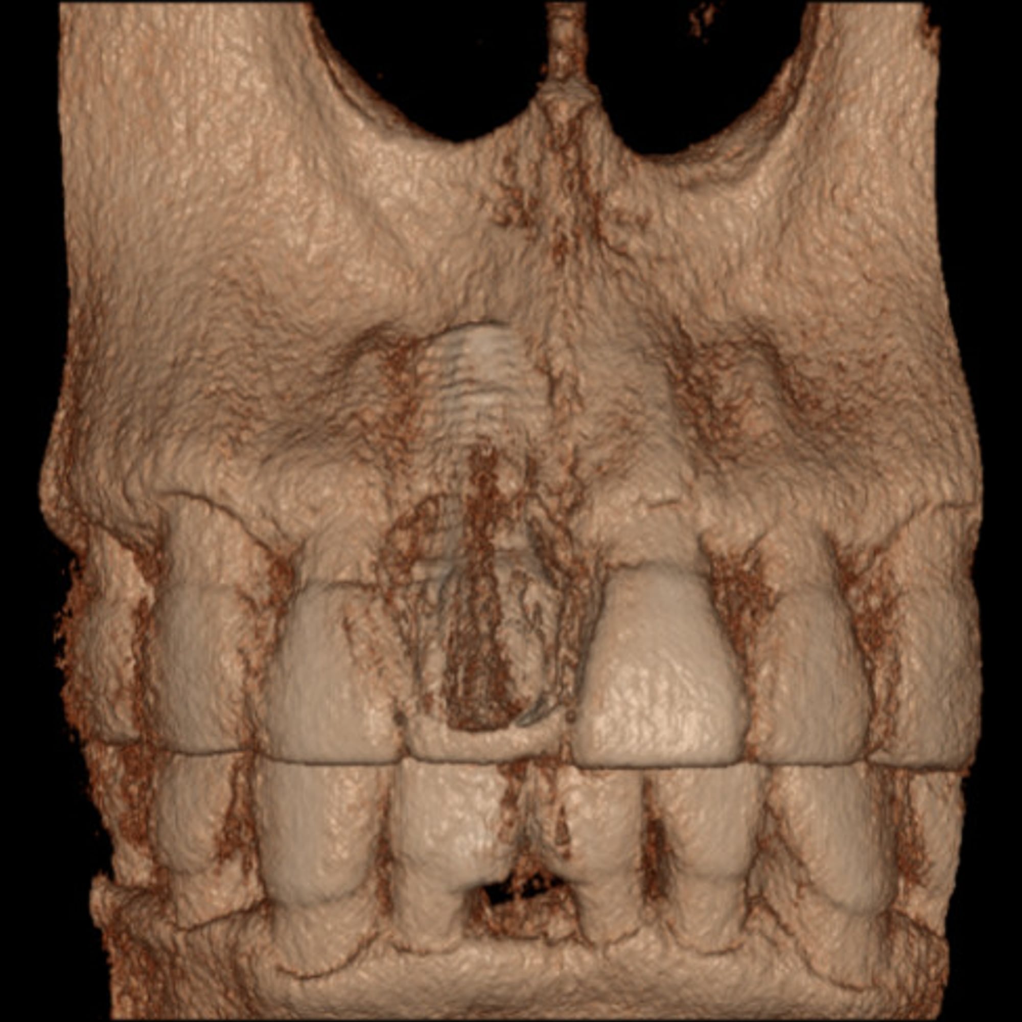 CBCT 3D reconstruction before treatment, the implant showing through the thin buccal plate