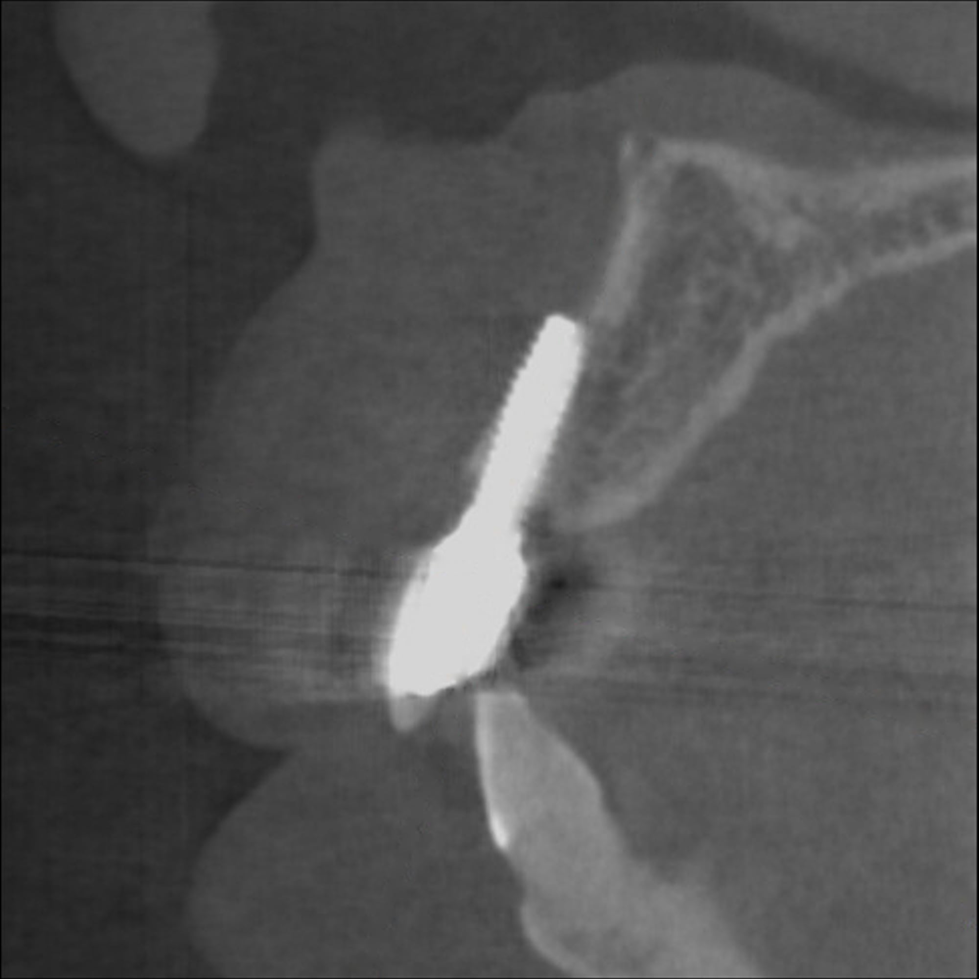 CBCT sagittal section before treatment, showing the peri-implant bone defect