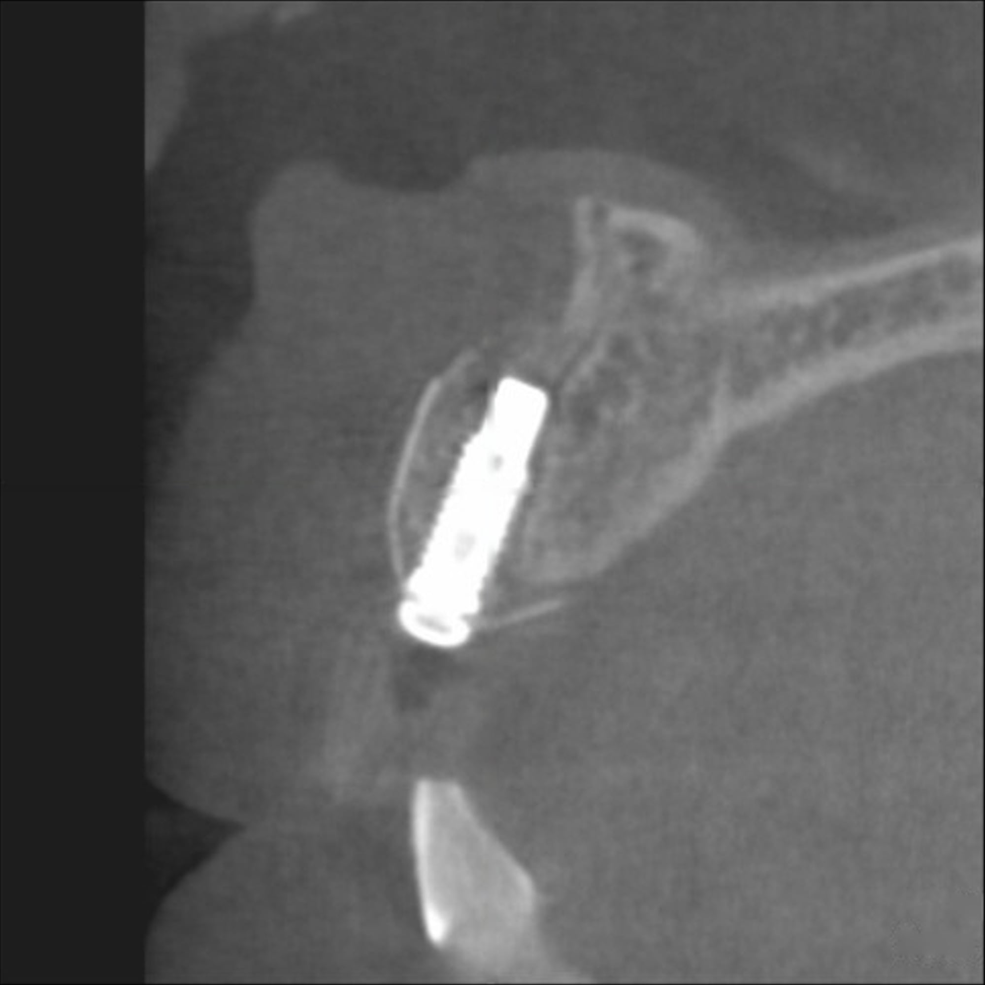 CBCT-Sagittalschnitt nach der Behandlung, das Implantat von regeneriertem Knochen umschlossen
