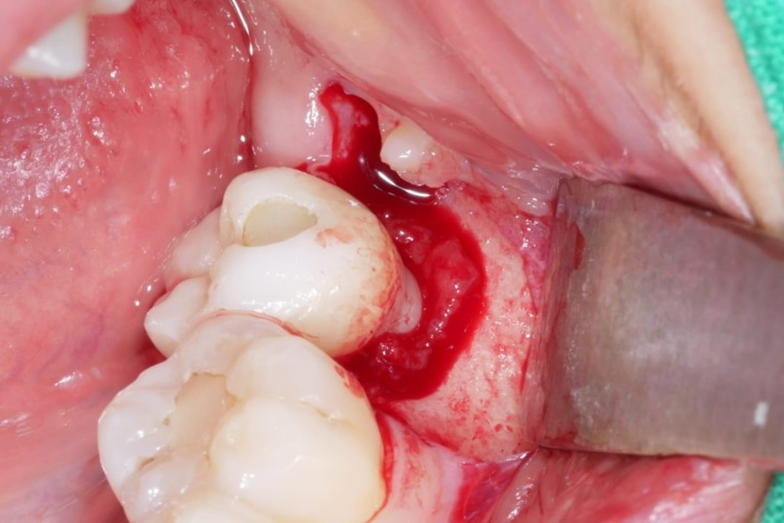 Posterior site with peri-implant defect before debridement
