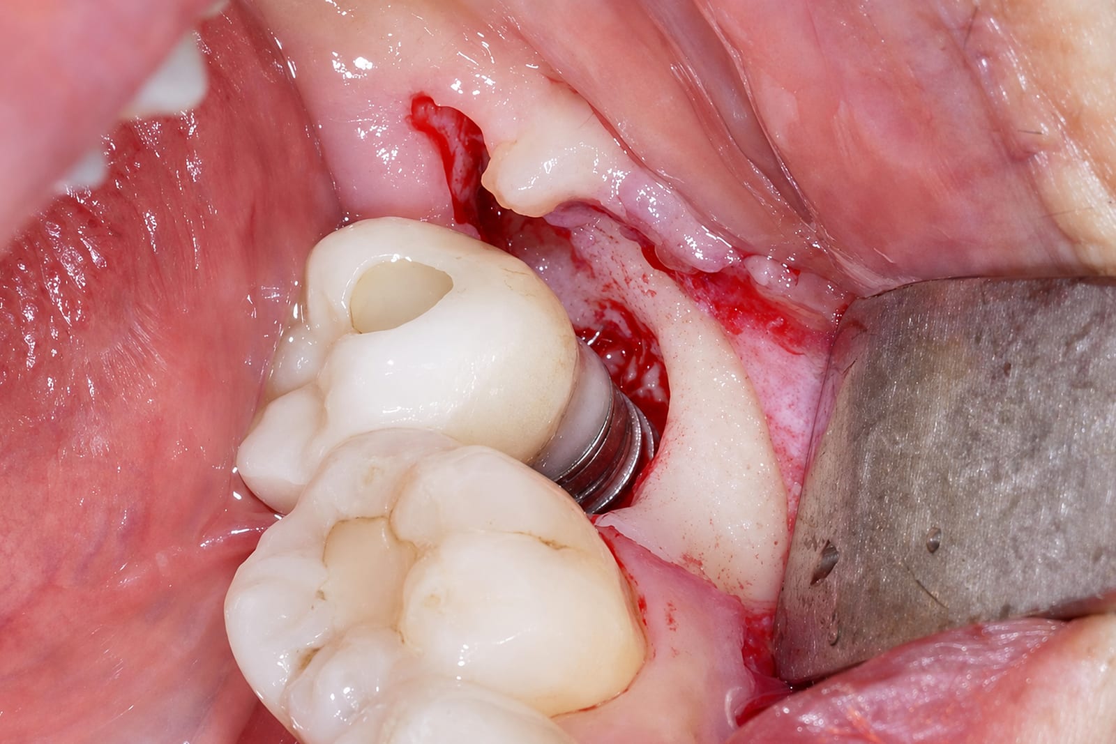 Derselbe posteriore Bereich nach dem Debridement mit der NiTi Brush