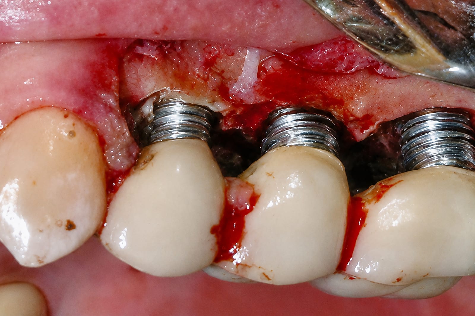 Dieselben drei Implantate nach dem Debridement mit der NiTi Brush, Gewindegänge hell und maschiniert