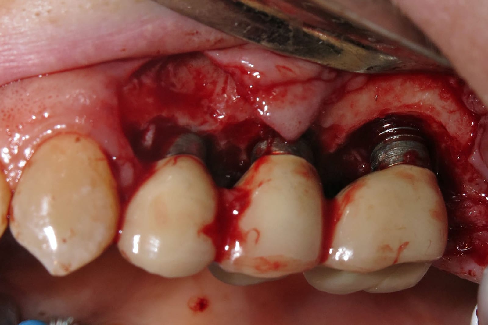 Drei benachbarte Implantate mit kontaminierten, freiliegenden Gewindegängen vor dem Debridement