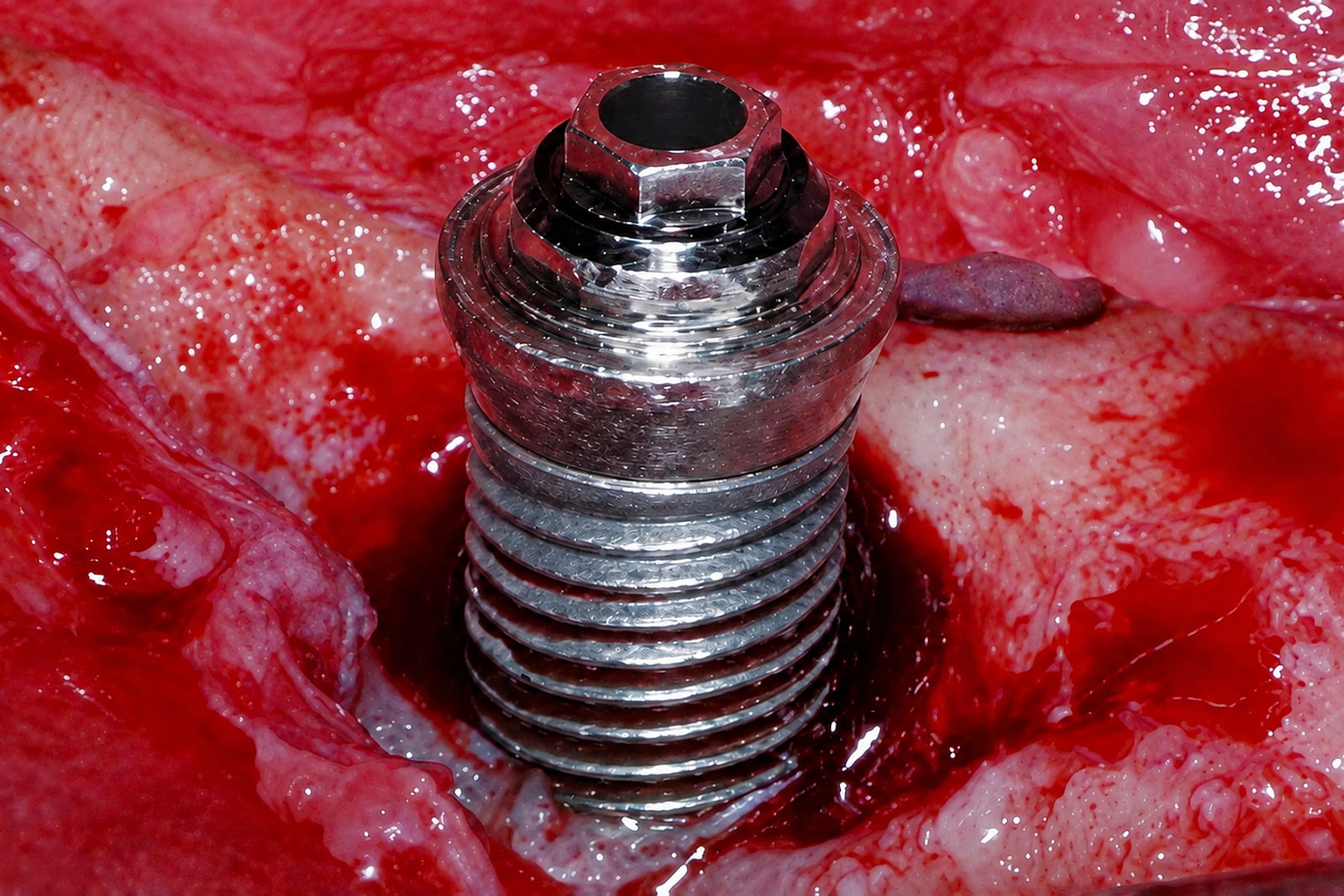 The same implant after debridement with the NiTi Brush