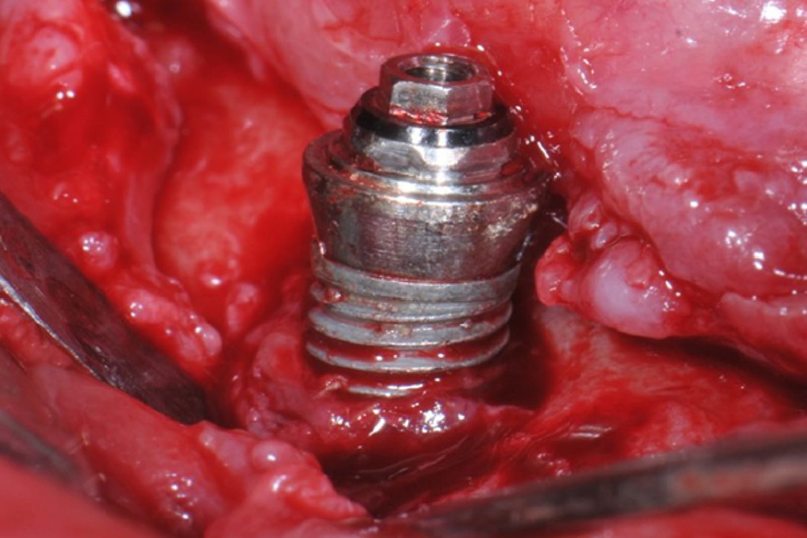 Exposed implant with peri-implantitis before debridement