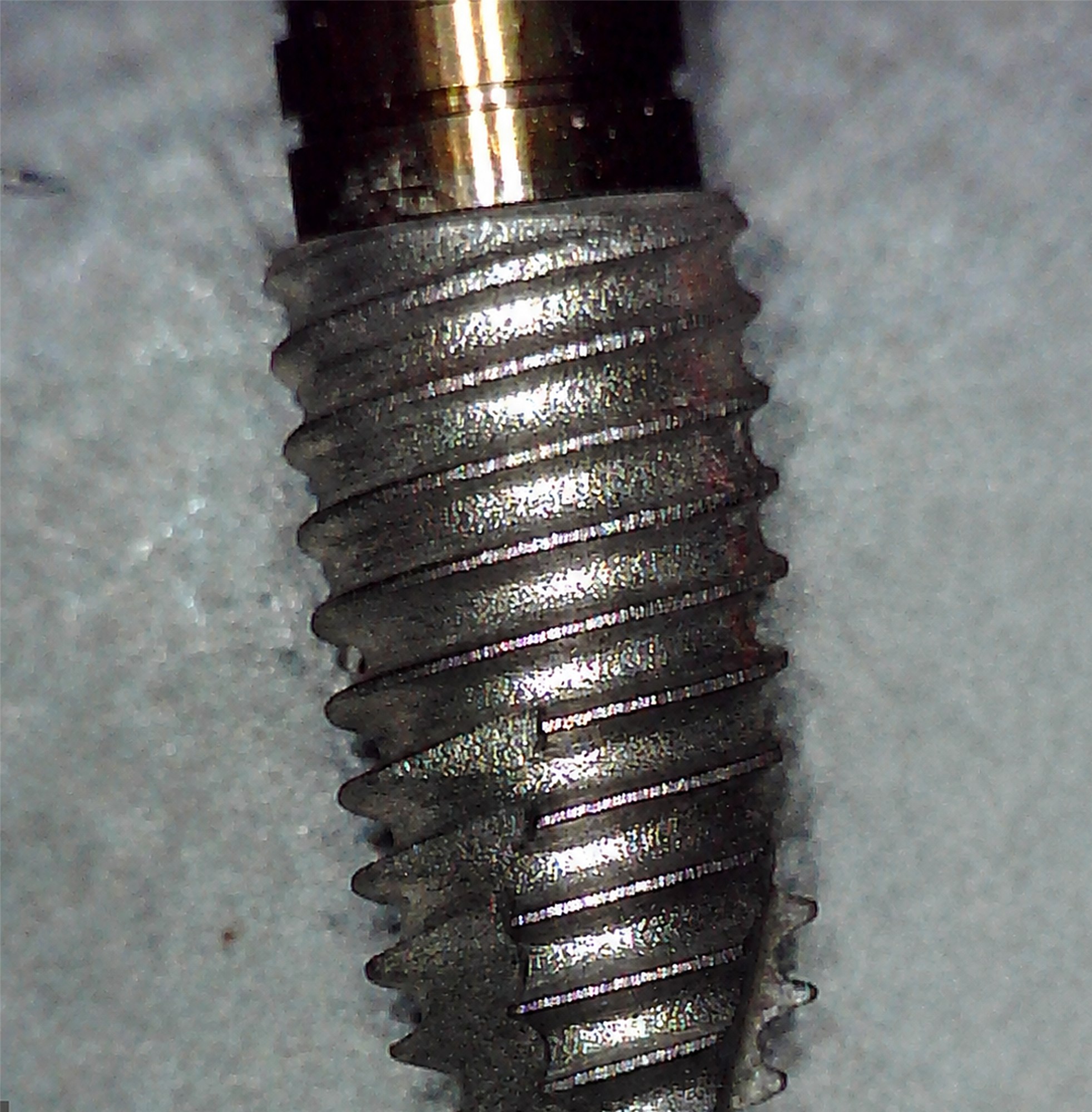 Impianto rimosso A02 dopo il debridement con il NiTi Brush