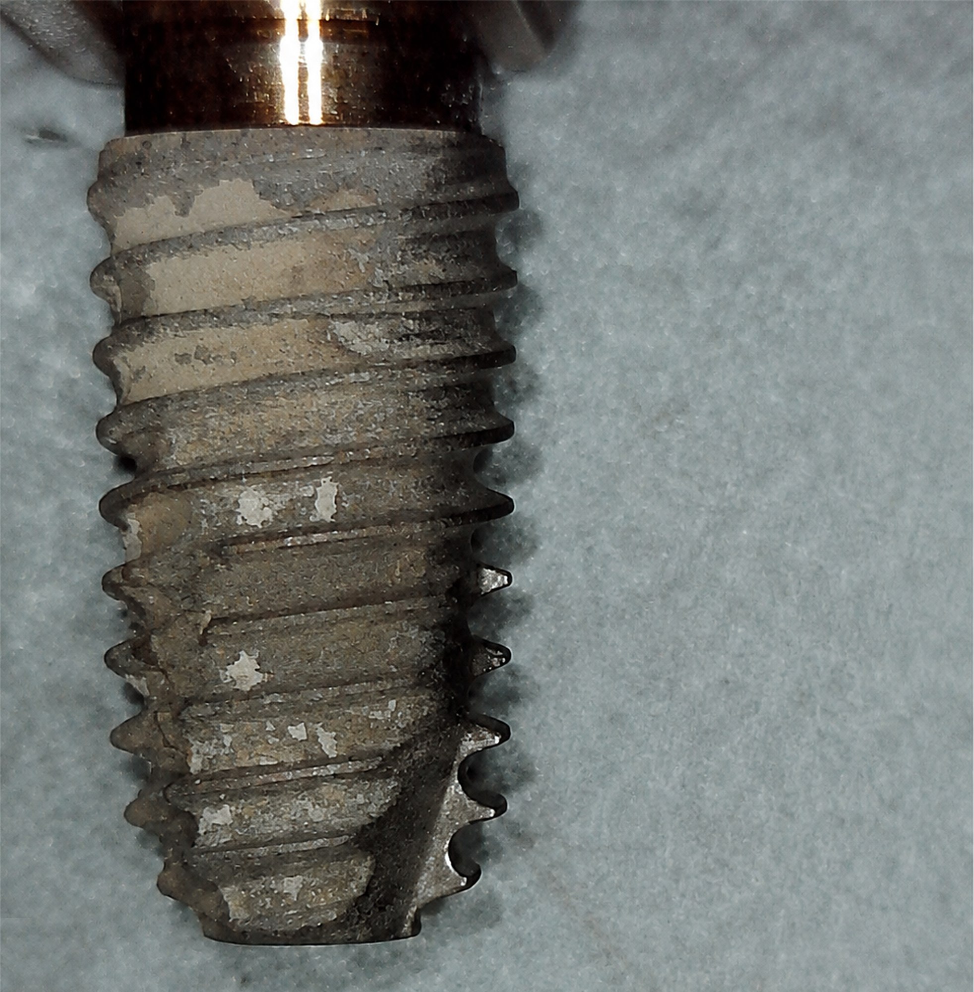Impianto rimosso A02 prima del debridement