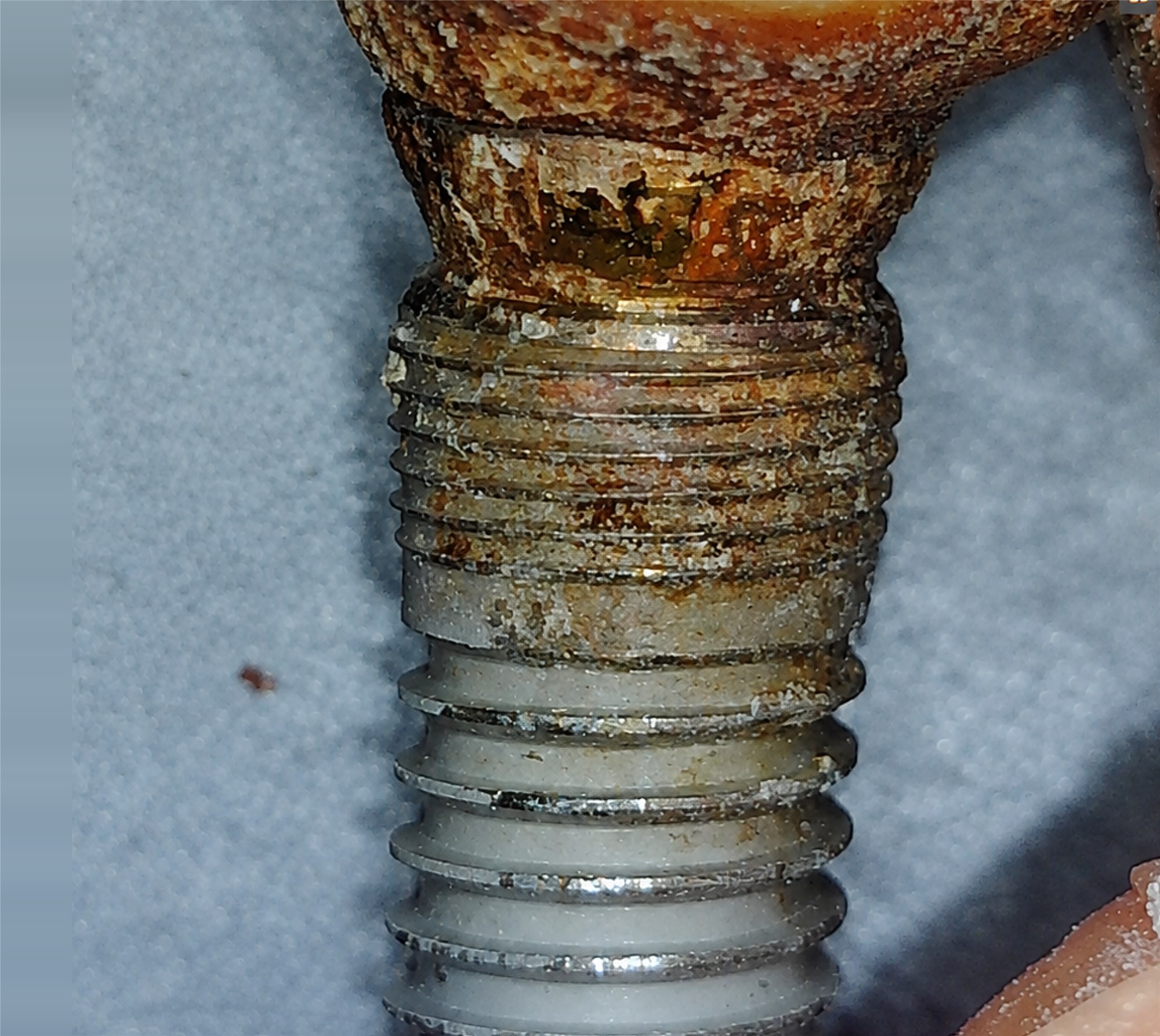Impianto rimosso A03 prima del debridement
