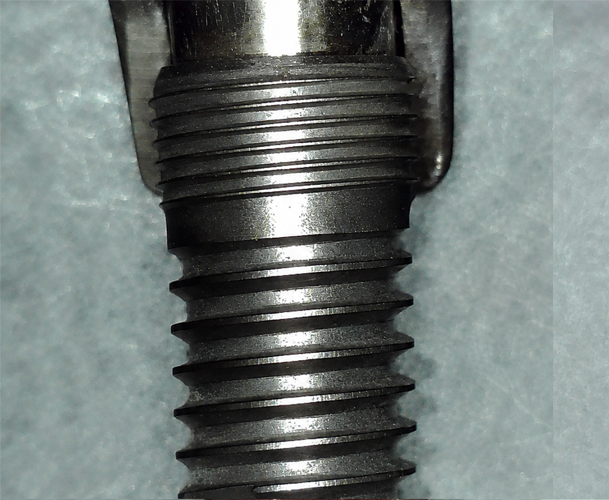 Impianto rimosso A04 dopo il debridement con il NiTi Brush