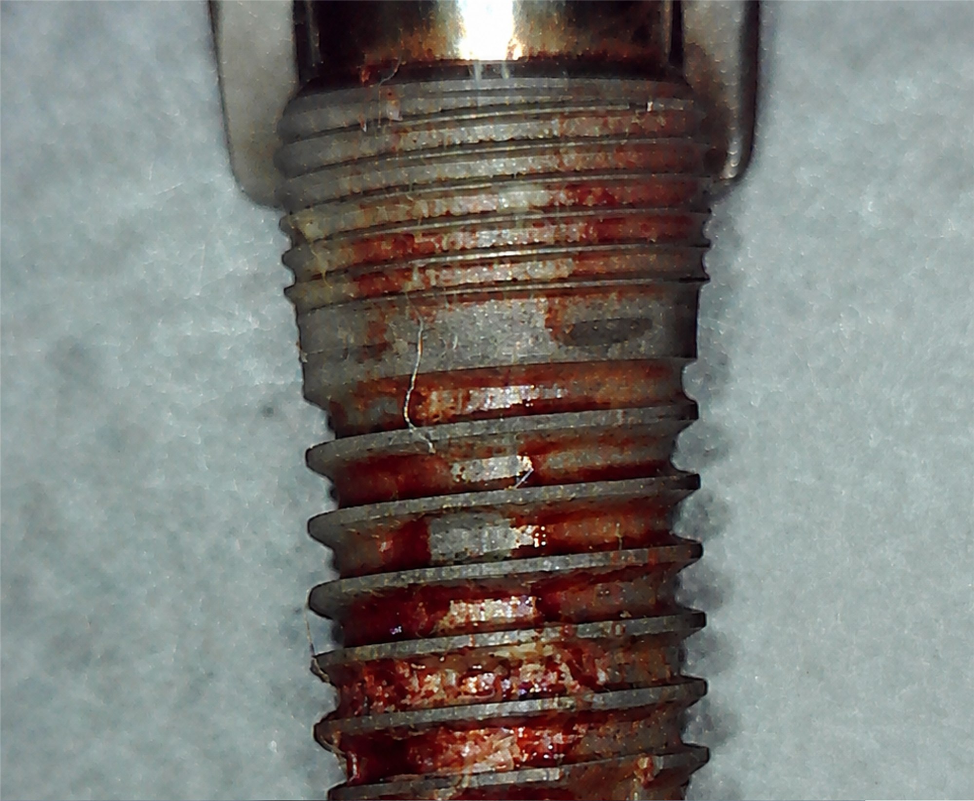 Impianto rimosso A04 prima del debridement
