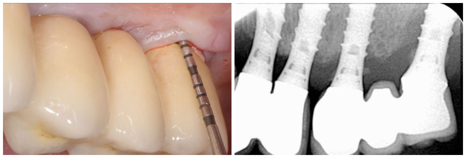 Sondaggio della tasca perimplantare, con la radiografia corrispondente