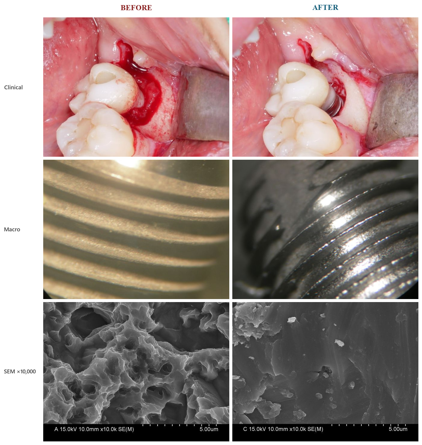 Superficie implantare prima e dopo la spazzolatura — viste clinica, macro e SEM