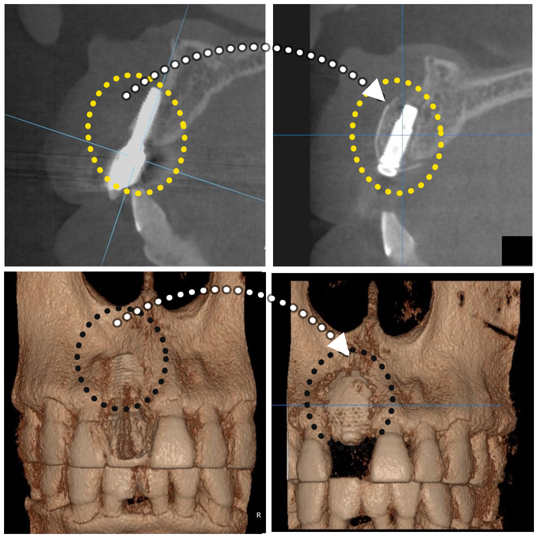 Sezioni sagittali CBCT e ricostruzioni 3D dello stesso impianto prima e dopo il trattamento