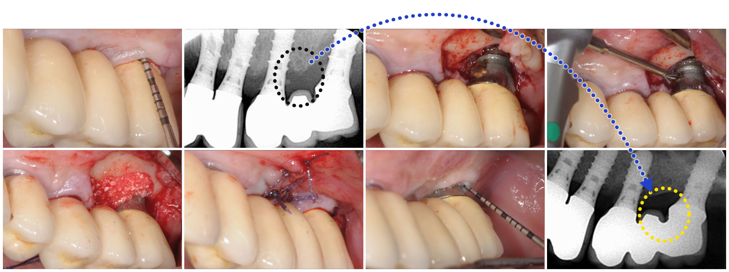 Sequenza completa del caso — sondaggio e radiografia alla diagnosi, impianto esposto, debridement con il NiTi Brush, innesto osseo, sutura, e sondaggio e radiografia al controllo