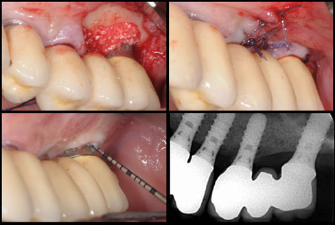 Clinical case by Dr. Mario Roccuzzo using NiTi Brush for peri-implantitis, view 2