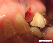 Removing the abutment