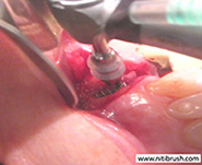 Debridement of the implant surface using the NiTi Brush