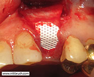 Guided bone regeneration step