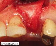 Guided bone regeneration step