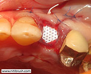 Guided bone regeneration step